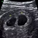 A Journey Through Twin Pregnancy: Ultrasound Milestones