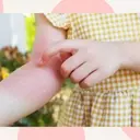 Understanding and Managing Common Skin Rashes in Toddlers
