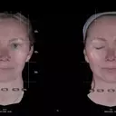 Aesthetic Enhancement: Exploring the Efficacy of XERF for Pre-Wedding Skin Rejuvenation