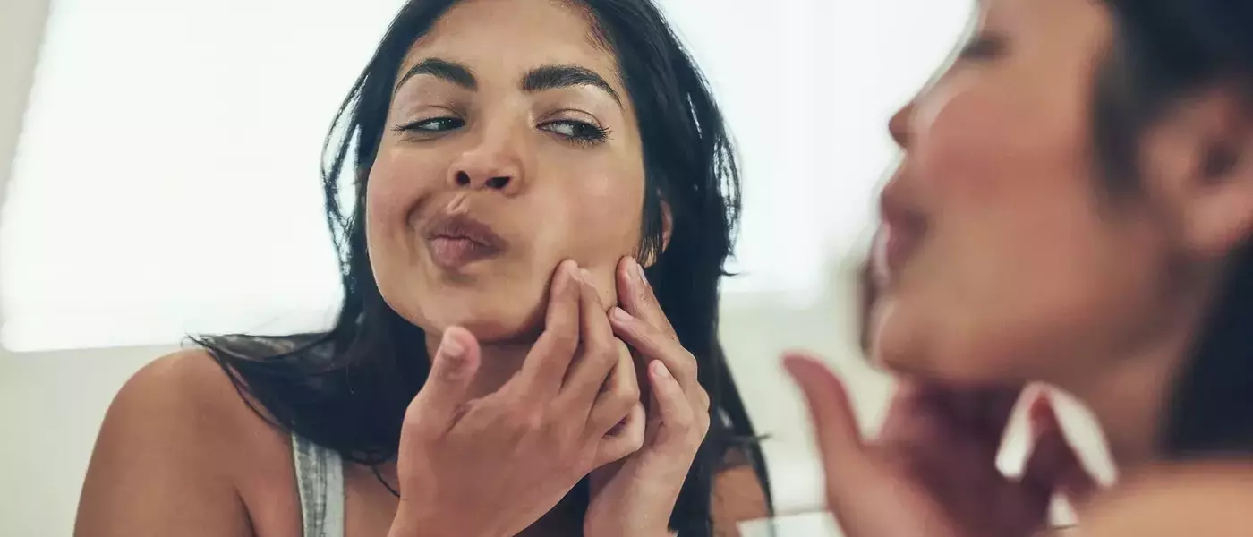 Understanding and Managing Postpartum Acne