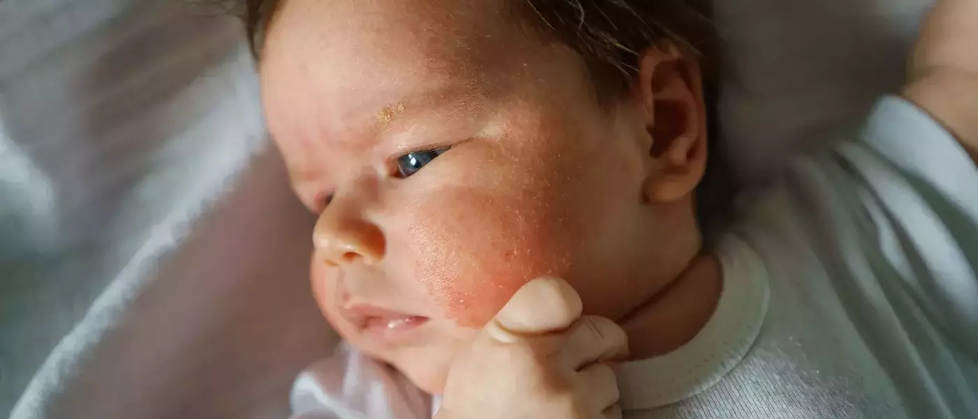 Common Rashes in Children: Identification and Management