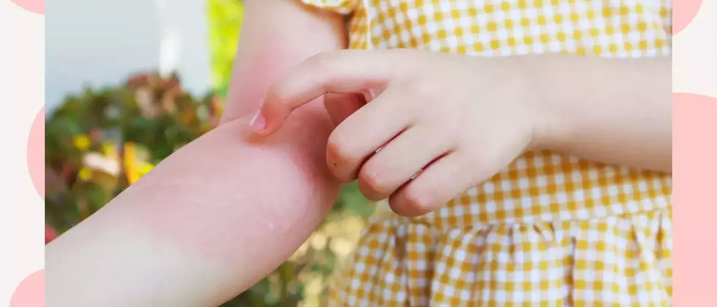 Understanding and Managing Common Skin Rashes in Toddlers