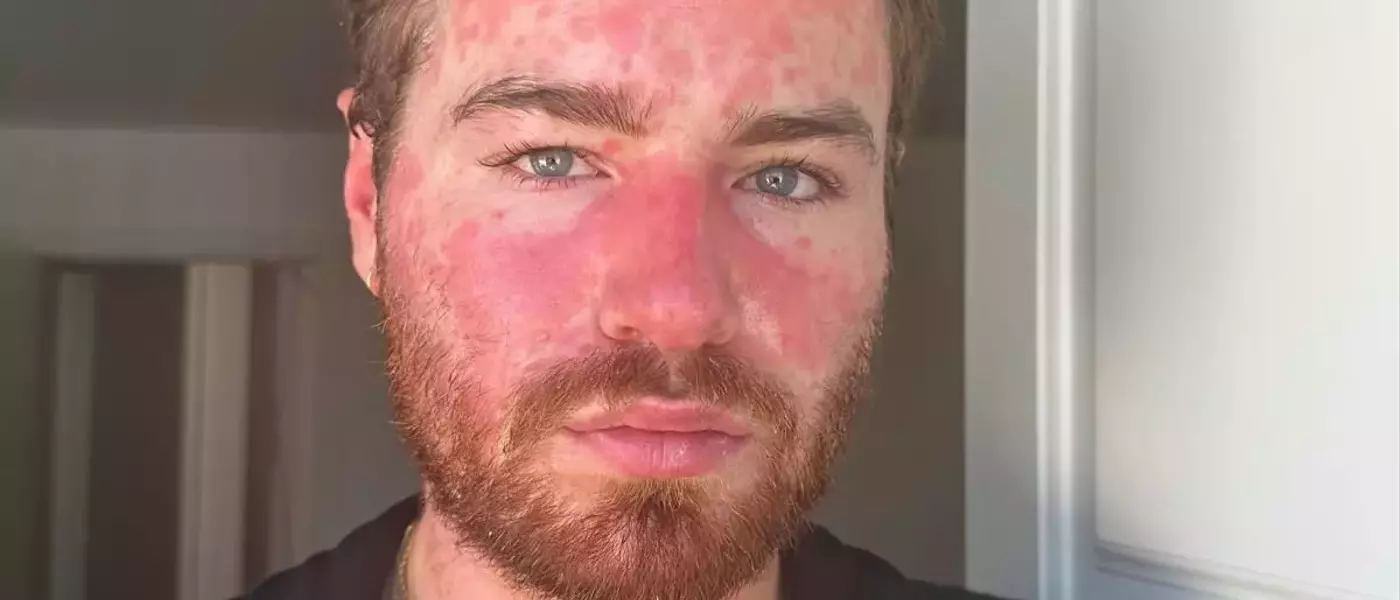 Exercising with Psoriasis: Embracing Activity and Self-Care
